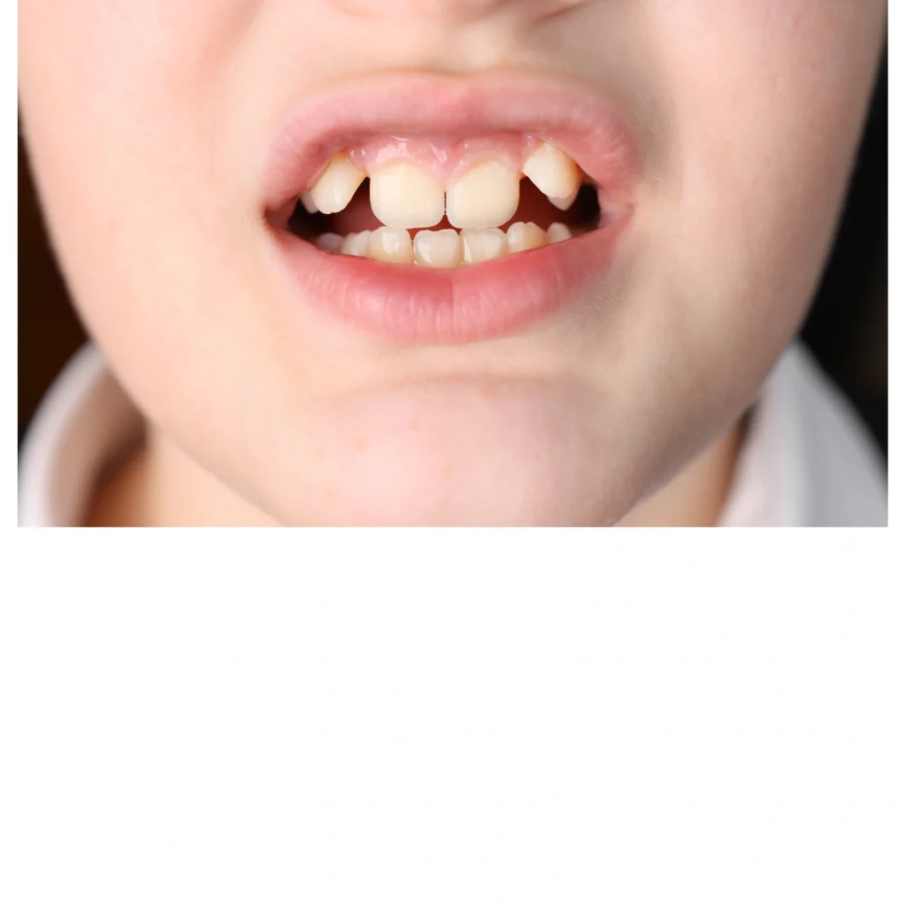 Crooked teeth