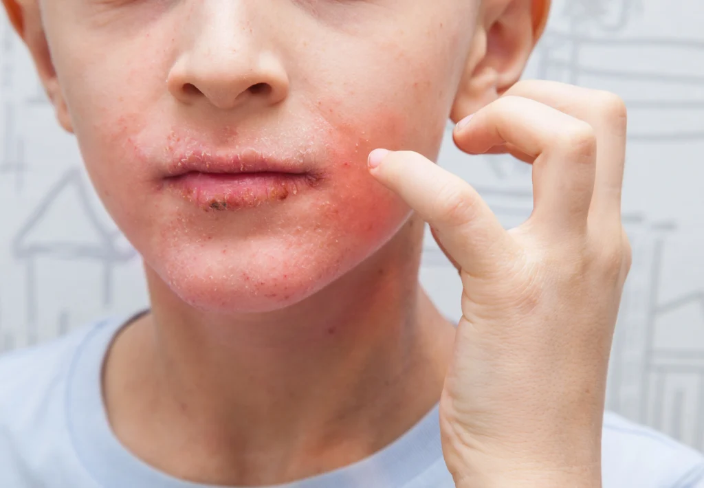 Image represents Cellulitis