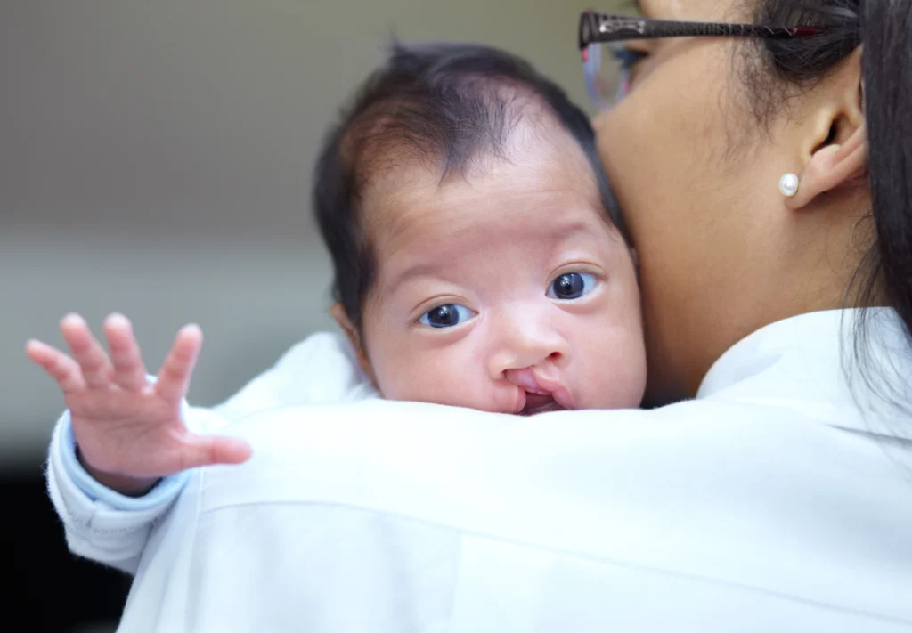 Image showing Cleft Lip and Palate treatment